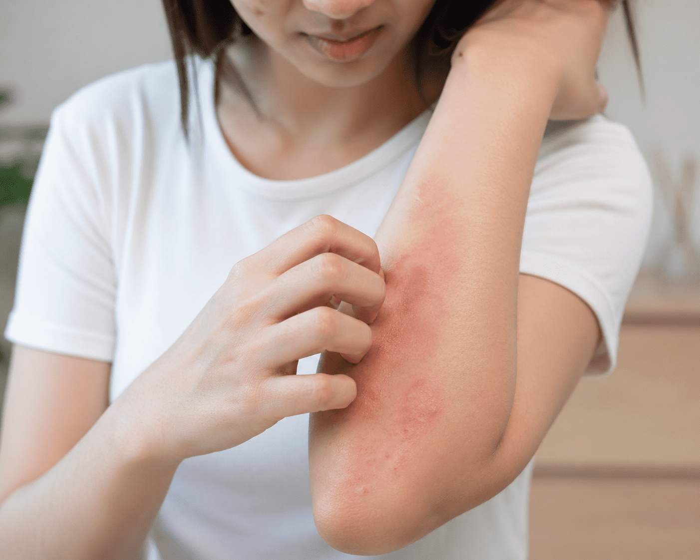 Natural Eczema Relief: 5 Things That Actually Work (And What to Avoid)